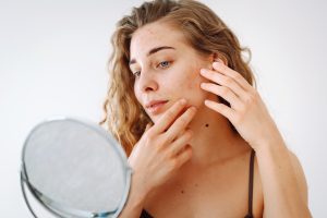 AR AKNĖ SUSIJUSI SU MITYBA?